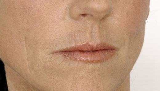 A Complete Guide to Understanding and Treating Barcode Wrinkles on the Upper Lips
